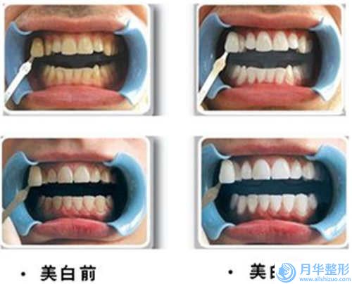 南宮市第二人民醫(yī)院價(jià)格(收費(fèi)標(biāo)準(zhǔn))人氣種草-腹部減肥吸脂費(fèi)用會(huì)不會(huì)太高