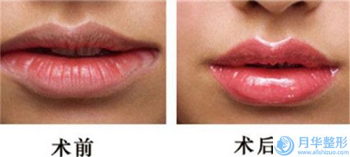 王歷整形醫(yī)生假體填充下巴人氣新秀盤點-石家莊王歷醫(yī)療美容