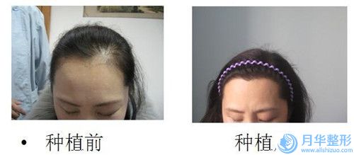 揚(yáng)州肌膚緊致面部提升術(shù)費(fèi)用貴嗎