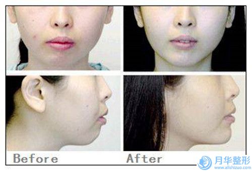 臺(tái)州Z成形法眉位不整矯正手術(shù)危害有哪些