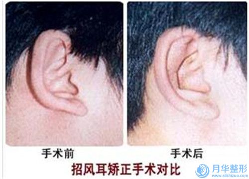 肇慶乳房下垂上提術(shù)的費(fèi)用比較高嗎