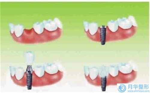 盤錦Botox瘦腿針瘦腿整形的價格要多少