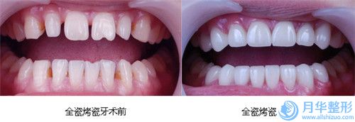 淮南市腰腹部吸脂吸脂費(fèi)用表明細(xì)發(fā)布(腰腹部吸脂吸脂均價(jià)為：17654元)