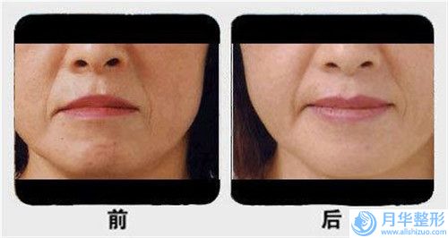 鞍山玻尿酸豐下巴手術(shù)整形價(jià)格一般需要多少錢