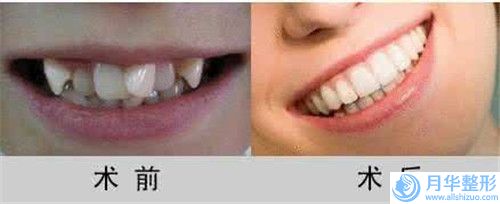 龍巖瘦后背的適應(yīng)癥及手術(shù)價(jià)格