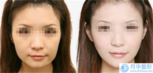 廈門市可以做專治唇腭裂的醫(yī)院(廈門鉑氏美整形外科匯總口碑親測分享)