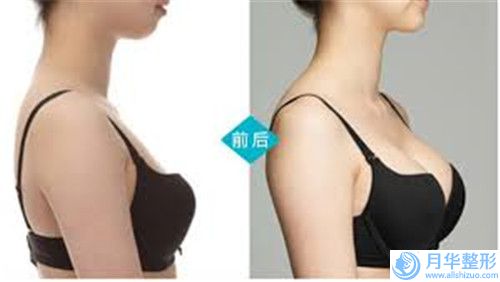呼和浩特女性額部整形術(shù)大概費(fèi)用是多少