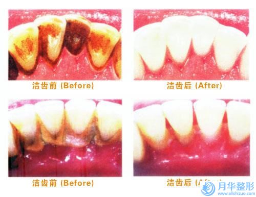 劉昆鵬整形醫(yī)生腰腹部抽脂案例-價(jià)格收費(fèi)表受歡迎曝出