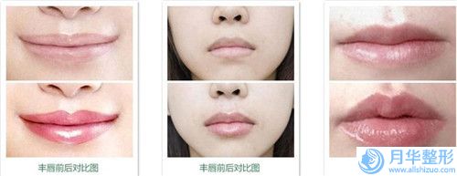 孫漫整形醫(yī)生硅膠假體植入隆下巴案例-收費(fèi)明細(xì)趨勢公開