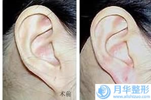 銅仁注射膠原蛋白豐胸術(shù)價格受什么因素影響