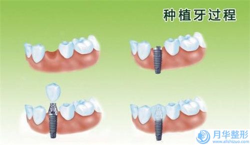 丹東治療吸脂的有效方法是什么