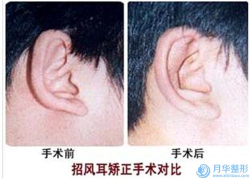 合肥華美醫(yī)療整形美容醫(yī)院縮小胸部手術(shù)攻略get