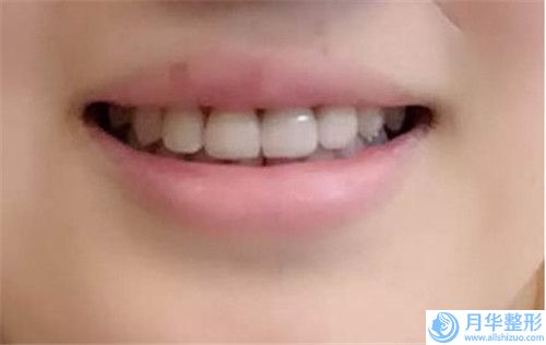 廊坊大腿超聲吸脂瘦大腿的費(fèi)用受哪些因素影響