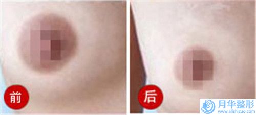 自貢打玻尿酸豐額的價(jià)格是受什么影響的