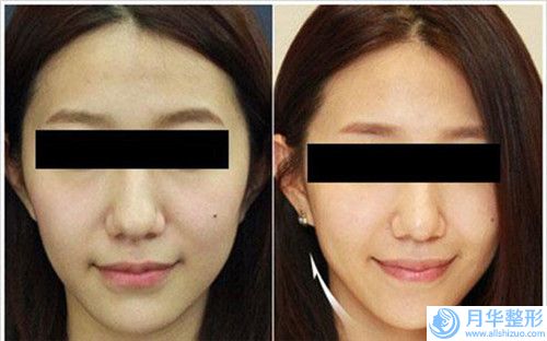 滄州市唇腭裂整容整形醫(yī)生哪位安全-汪濟廣醫(yī)生技術好收費不坑人