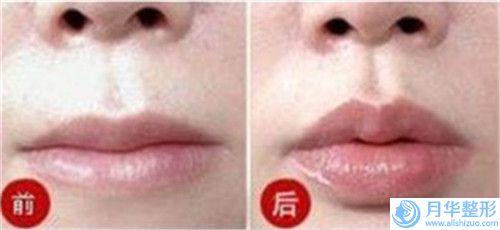 攀枝花市填下巴價格(價目)表醫(yī)生介紹參考-攀枝花市填下巴手術(shù)需要價格