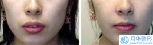 中國下巴縮矯正手術(shù)良好的醫(yī)生-撫順市下巴縮矯正手術(shù)專家上榜清單