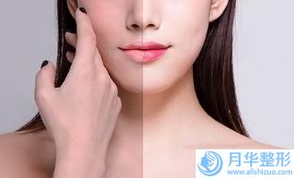 張掖安法硅膠墊下巴手術(shù)正規(guī)醫(yī)院的費(fèi)用