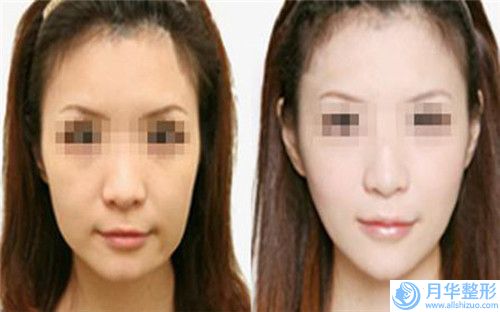 衡水唇裂2度整形費(fèi)用是多少-衡水唇裂2度的手術(shù)價(jià)格大致是多少