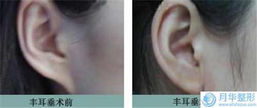 河北省水滴形假體隆胸哪個(gè)整形醫(yī)院安全(承德醫(yī)學(xué)院附屬醫(yī)院行業(yè)領(lǐng)頭)
