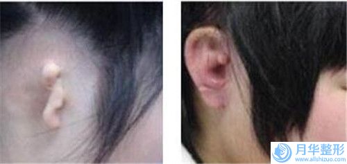 玉溪硅膠隆胸整形術(shù)做一次多少錢