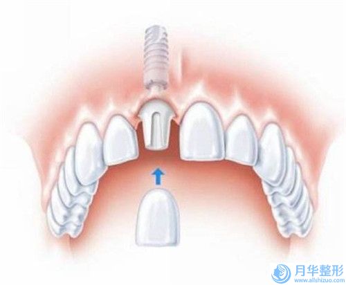 梅州手術(shù)法腹部減肥術(shù)要花費多少