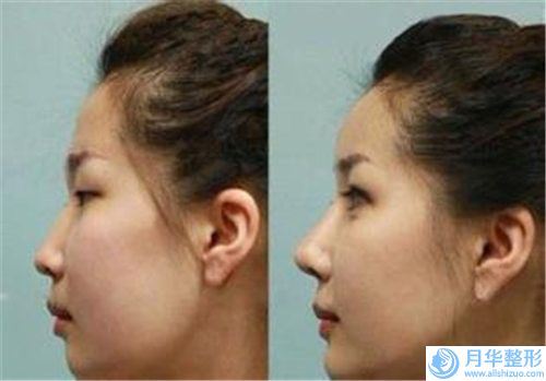 大連恩盈美地星海醫(yī)療美容診所價位表全新傾情呈現(xiàn)-假體隆鼻硅膠案例