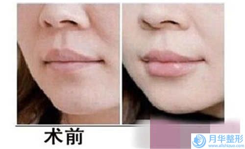 黑龍江省豐下巴矯形價(jià)格表全新曝出(豐下巴矯形均價(jià)為：10058元)