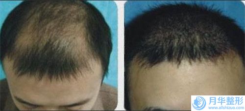 湛江整容打瘦臉針會(huì)不會(huì)出現(xiàn)副作用呢