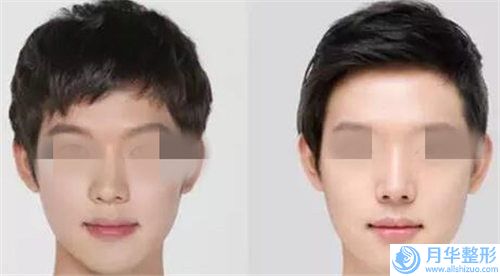珠海做自體隆鼻手術貴不貴需要多少錢
