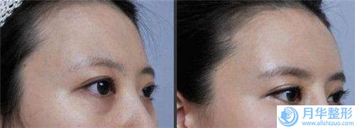 懷化半長久洗眉手術(shù)的價格因素是什么