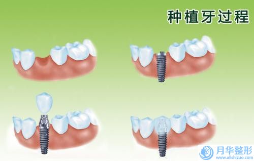 做吸脂提臀的作用及效果介紹,做吸脂提臀效果真的那么好嗎