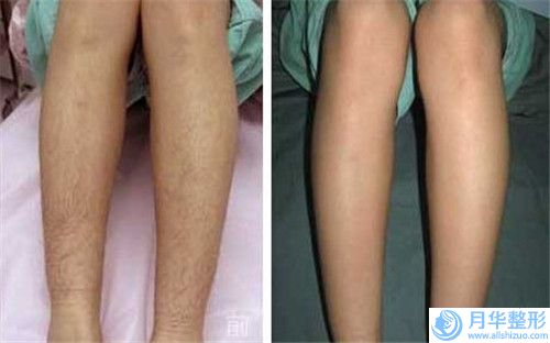 中國醫(yī)院膨體豐臉頰多少錢：膨體豐臉頰醫(yī)院50強(qiáng)強(qiáng)勢(shì)回歸
