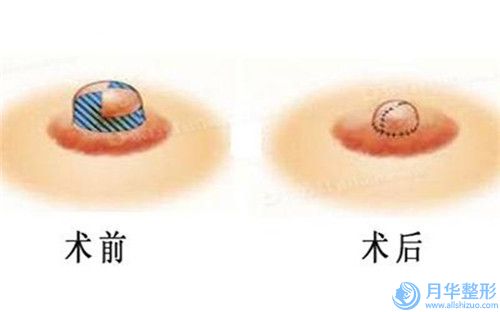 全國額頭小拉皮手術(shù)醫(yī)院推薦：額頭小拉皮手術(shù)醫(yī)院前50名get
