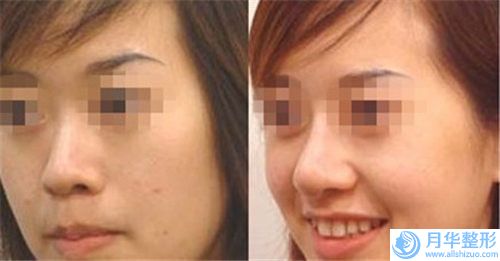 臨汾縮小鼻頭整形安全性如何