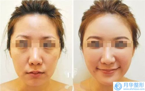 玉林自身脂肪豐唇價(jià)格的兩大因素