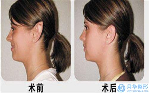 滄州自體脂隆胸術(shù)可以維持多長時(shí)間