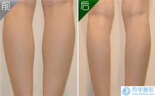 勇中華牙齦骨頭突起效果圖對(duì)比
