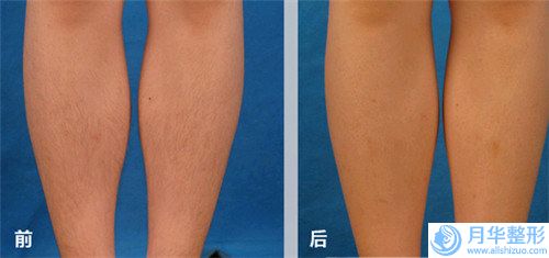 安慶市男生瘦臉針費(fèi)用表明細(xì)熱門項目公示(男生瘦臉針均價為：4911元）