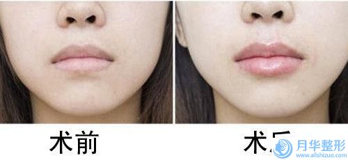 盤錦市艾莉薇填充下巴價格(價目)表下個月公布-近8個月均價為2269元