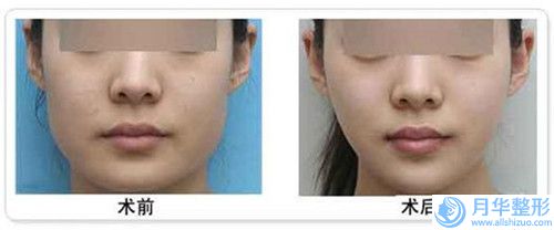 鄭州健麗醫(yī)美立體文眉手術一般要多少價格