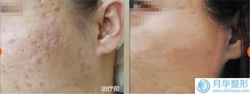 俞良鋼注射豐太陽穴的費(fèi)用要多少錢呢