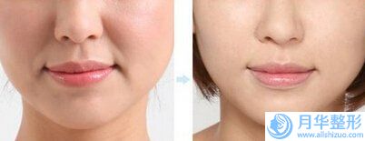 楊智明整形醫(yī)生出名嗎醫(yī)生痘印激光去除實力、個人資料詳情、案例反饋