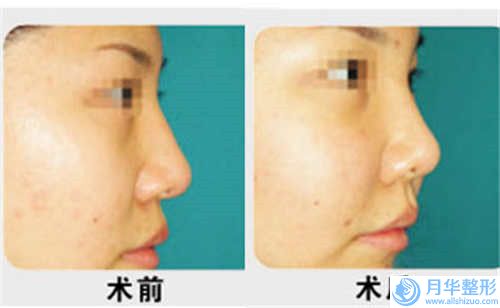廣元自體脂肪豐下巴手術(shù)手術(shù)前后效果對(duì)比圖