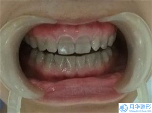 玉林全腹吸脂手術(shù)效果如何 安全嗎