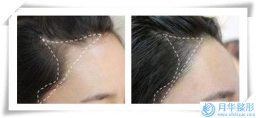 鐵嶺德爾美客醫(yī)療美容門診部?jī)r(jià)格價(jià)位表怎么樣全新一覽-臉上黃雀斑消除案例