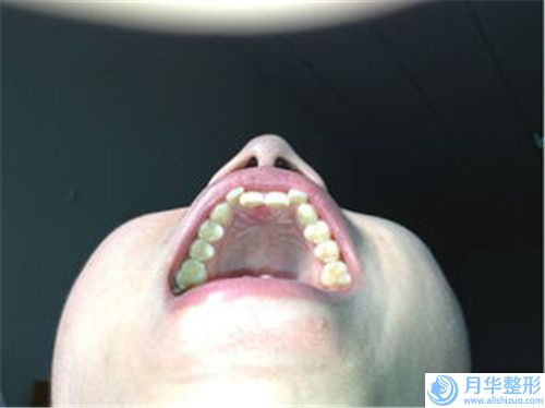 煙臺水動力吸脂術可能會有什么后遺癥