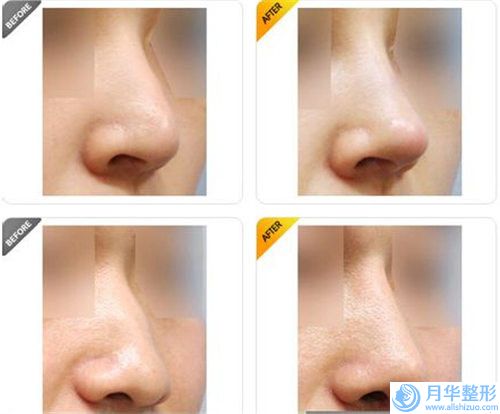 呂梁自體隆鼻整容價格不穩(wěn)定受哪些因素影響
