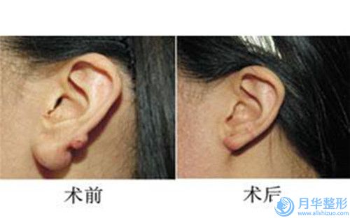 寧波海曙澳瑪星光悅?cè)菡吾t(yī)院收費(fèi)明細(xì)整理-女孩子豐胸案例