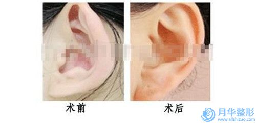 昭通胸部下垂手術(shù)矯正的原理及價(jià)格